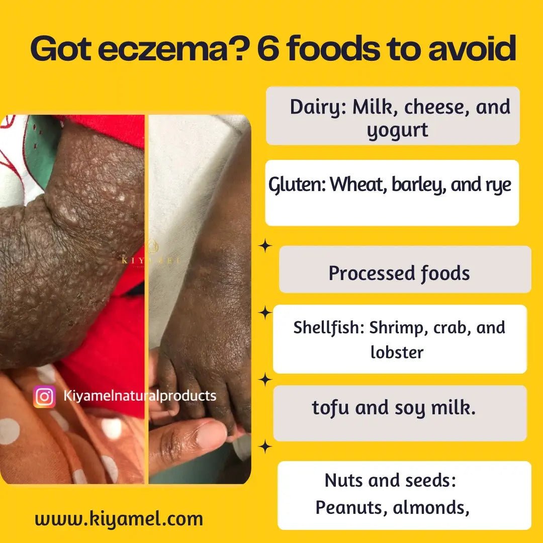 "6 Foods to Avoid for Better Eczema Management - Kiyamel