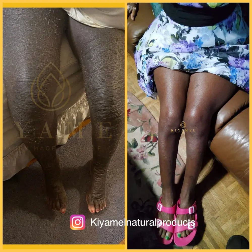 The Benefits of Using Natural Ingredients in Eczema Skincare Products - Kiyamel