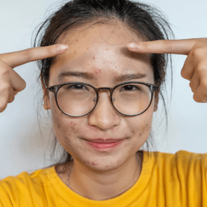 Eczema Prone Skin