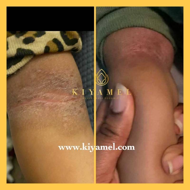 10Before and After use Kiyamel skin care products