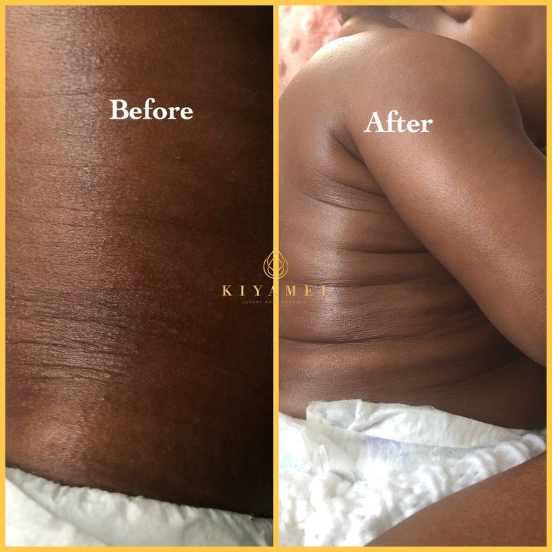 13Before and After use Kiyamel skin care products