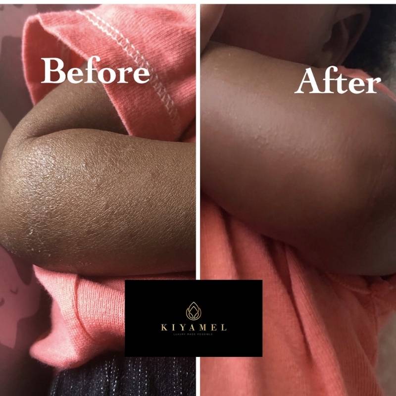 1Before and After use Kiyamel skin care products