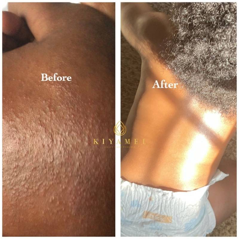 2Before and After use Kiyamel skin care products