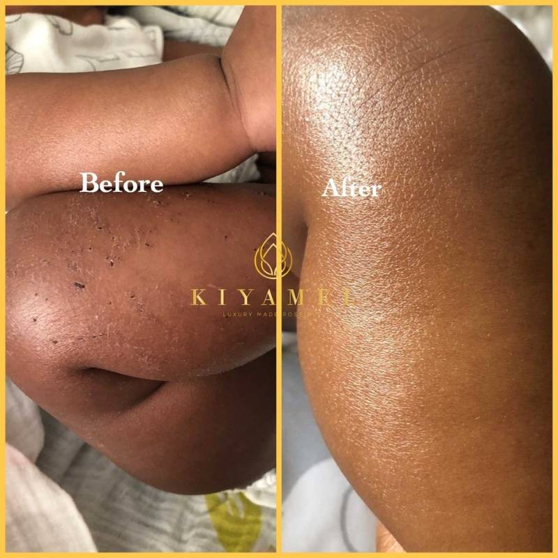 5Before and After use Kiyamel skin care products