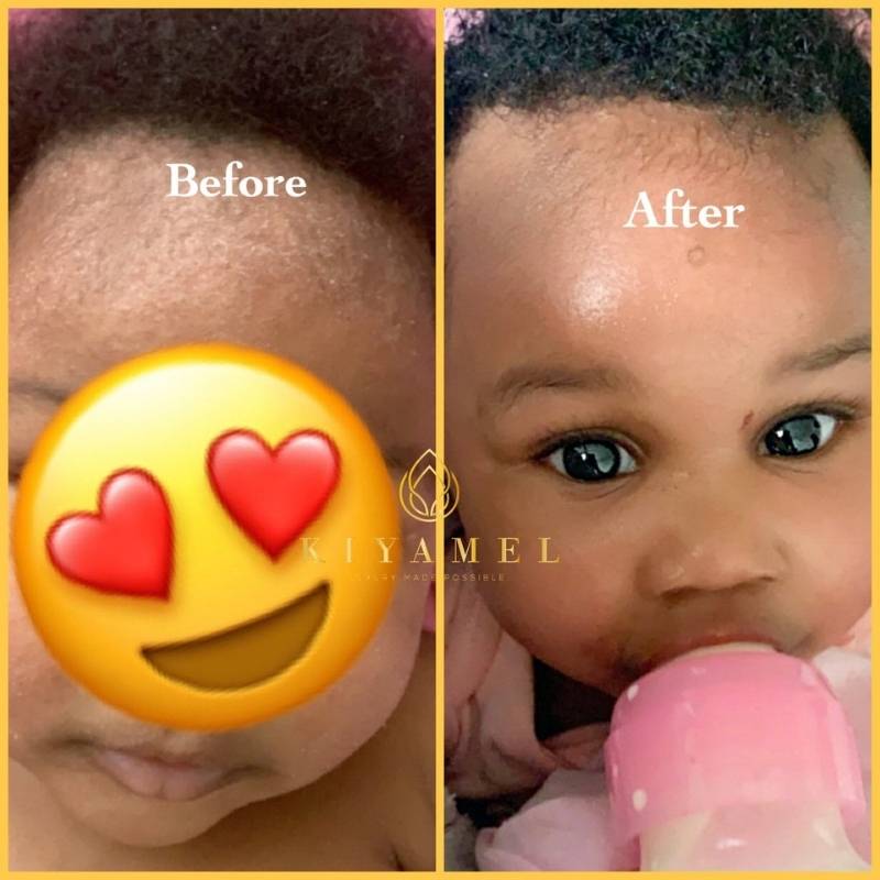 6Before and After use Kiyamel skin care products